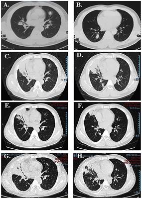 Case report: Corticosteroid-resistant acute fibrinous and organizing pneumonia with myelodysplastic syndrome